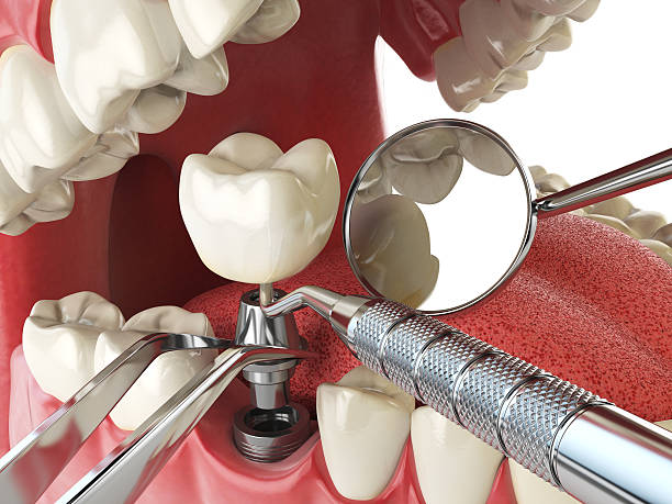 Best Emergency Wisdom Teeth Removal in Echelon, NJ